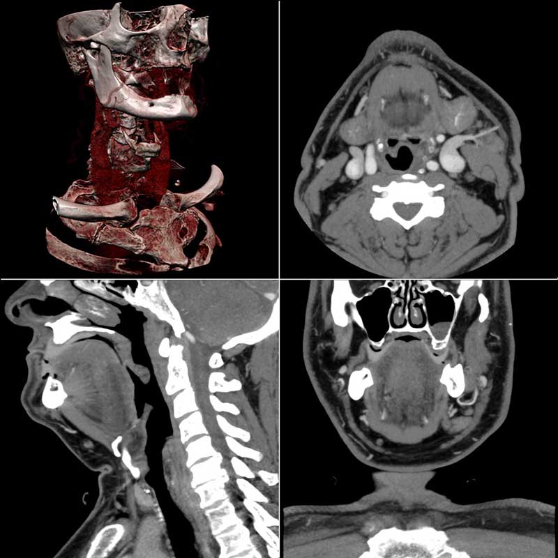 CT scan of the human neck