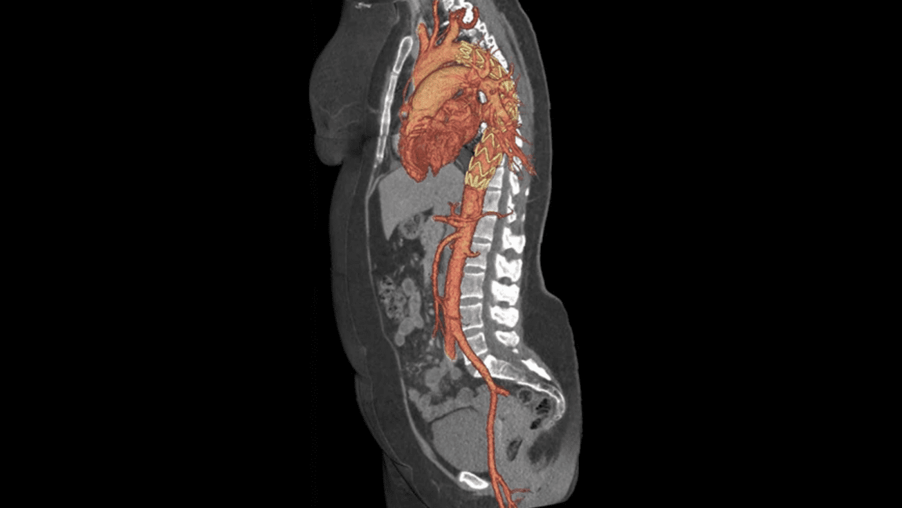 whole aorta CT scan taken during a transcatheter aortic valve replacement (TAVR) procedure using a GE Revolution HD unit.